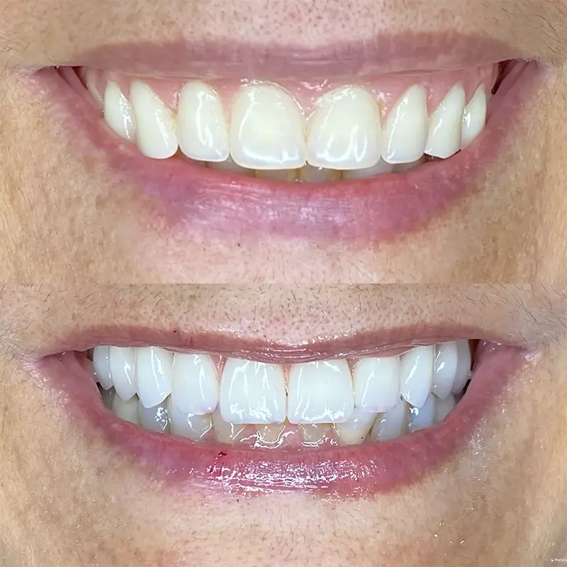 Implantes Dentarios — Dra. Larissa Andreo Maringa