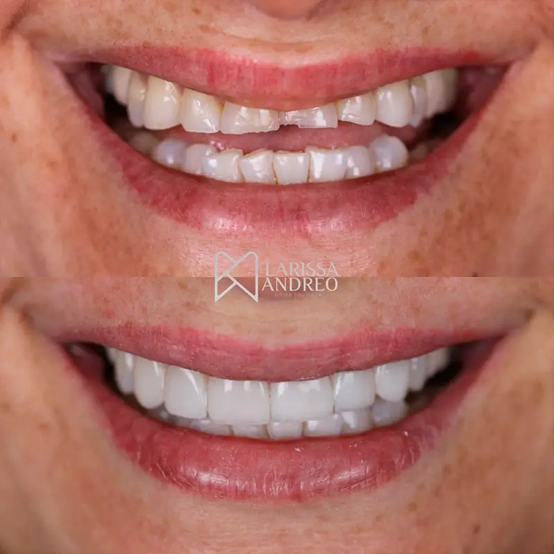 Facetas em Resina — Dra. Larissa Andreo Maringa