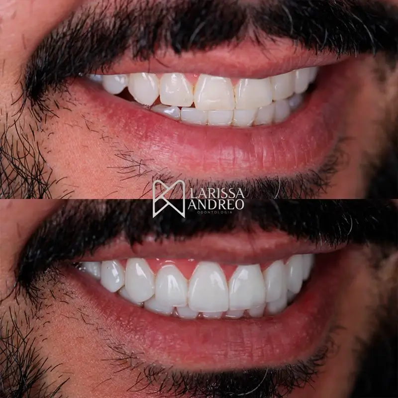 Caso real de Facetas em Resina — Dra. Larissa Andreo
