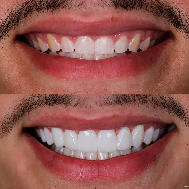 Caso real de Facetas em Resina — Dra. Larissa Andreo
