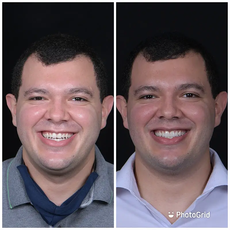 Caso real de Lentes em Porcelana — Dra. Larissa Andreo