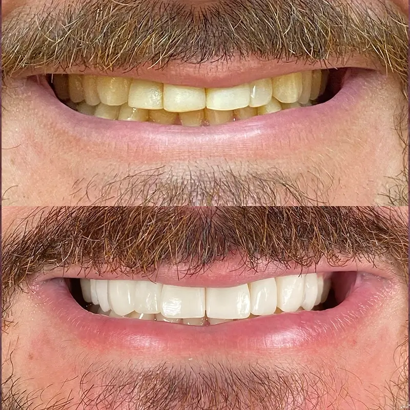 Caso real de Lentes em Porcelana — Dra. Larissa Andreo