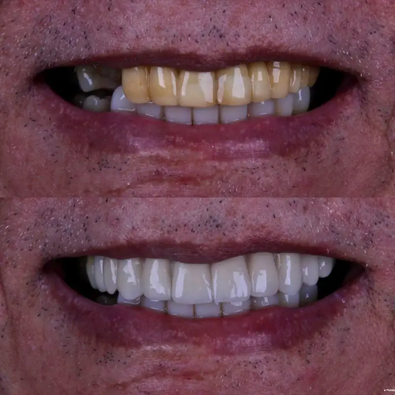 Caso real de Lentes em Porcelana — Dra. Larissa Andreo