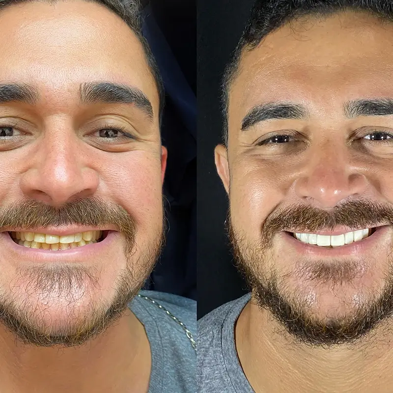 Caso real de Lentes em Porcelana — Dra. Larissa Andreo