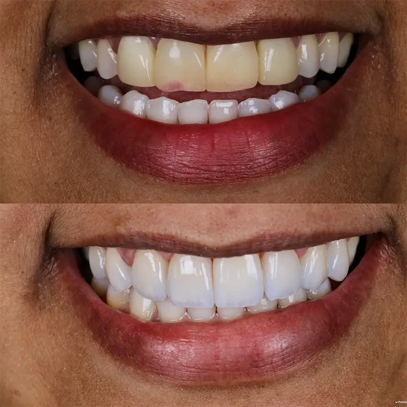 Caso real de Lentes em Porcelana — Dra. Larissa Andreo